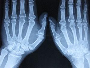 Carpitis erosiva en radiografía simple de la mano derecha de un paciente con APso.