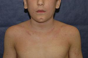 Paciente de 10 años de edad con una historia de un año de dermatitis localizada en la cara y el cuello secundaria a alergia por contacto a fragancias.