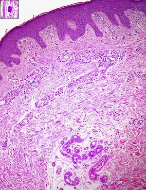 Biopsia de una de las lesiones (hematoxilina-eosina x 10). Leve acantosis, proliferación de vasos dérmicos de endotelio prominente e infiltrado linfohistiocitario con células multinucleadas. En el recuadro superior se destaca una de las células multinucleadas.