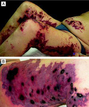 A. Numerosas úlceras en el abdomen, las nalgas y las extremidades inferiores. B. Úlceras eritemato-violáceas de bordes bien delimitados y zona central necrótica.