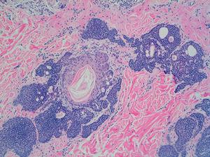 Lesión constituida por nidos de células basalioides y quistes córneos que se disponen en la dermis en relación con los folículos pilosebáceos (H-E, x100).