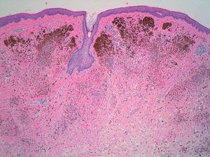 Proliferación melanocítica dérmica de células epitelioides y fusiformes, algunas intensamente pigmentadas, en el seno de un estroma colágeno (H-E, x40).