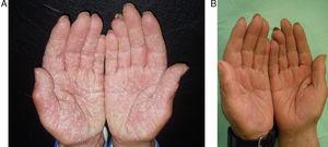 A. Paciente con eczema de manos hiperqueratósico antes del tratamiento con alitretinoína oral. B. «Manos limpias»al mes de tratamiento.