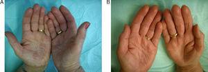 A. Paciente con eczema de manos alérgico antes del tratamiento con alitretinoína oral. B. «Manos limpias» al mes y medio del tratamiento.
