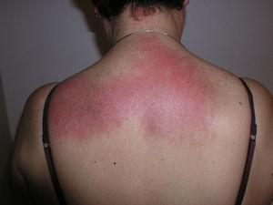 Signo del chal. Eritema violáceo macular confluyente en la parte posterior del cuello, espalda y hombros.