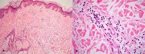 A. Eritema crónico migrans (HE, x 100). B. Escaso infiltrado inflamatorio crónico linfocitario con eosinófilos y células plasmáticas (HE, x 400).