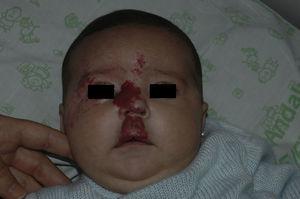 Hemangioma infantil segmentario en regiones S1, S2 y S4 en niña de 2 meses de vida. Se apreciaba importante deformidad en columela nasal y filtrum labial. El estudio complementario descartó síndrome PHACE.
