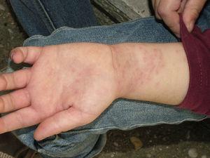 Erupción papulosa eritematosa en la cara anterior de la muñeca y la palma de la mano de una niña de 7 años de edad.