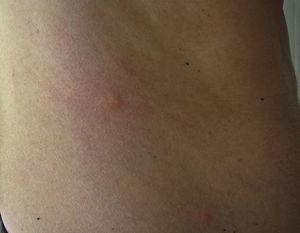 Dermatitis papulosa con lesiones de rascado y eccematización secundaria en el costado de un varón de 25 años de edad.
