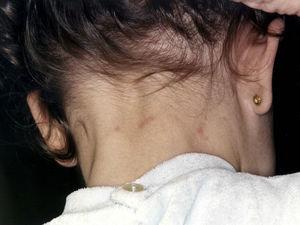 Pápulas eritematosas en la cara posterior del cuello de una niña de 3 años de edad.