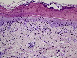Imagen histológica en la que se observa una vesícula con restos de leucocitos y suero coagulado. En la epidermis que forma su base se aprecia leve espongiosis y exocitosis de eosinófilos, y en dermis superficial un infiltrado predominantemente perivascular de linfocitos y eosinófilos.