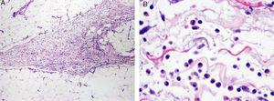 Imagen histopatológica de biopsia de antebrazo. A. Septo interlobular engrosado en el tejido celular subcutáneo (TCS) con celularidad inflamatoria (hematoxilina-eosina x 40). B. A mayor aumento se observa la presencia de numerosos eosinófilos en el TCS periseptal (hematoxilina-eosina x 400).