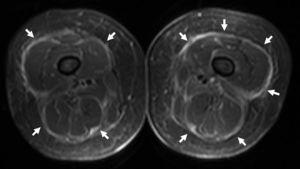 Resonancia magnética de miembros inferiores. Imagen axial STIR. Se aprecia una fascia muscular engrosada e hiperintensa (flechas).