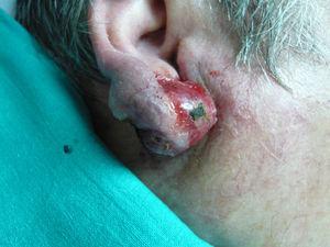 Lesión tumoral en lóbulo de pabellón auricular derecho.