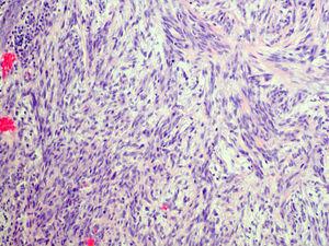 Imagen histológica de la lesión con patrón de crecimiento tumoral formado por células fusiformes de núcleos elongados con marcada atipia y presencia de células gigantes. (Hematoxilina-eosina 20x).