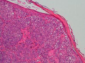 Melanoma de extensión superficial: la epidermis suprayacente está constituida en algunas zonas sólo por una capa de células (H/E ×100).