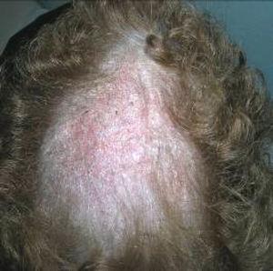 Placa alopécica y descamativa de 3 meses de evolución localizada en el cuero cabelludo del caso número 1.