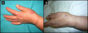 Varón de 72 años que presentaba un QA en el dorso de la mano izquierda (caso 8, tabla 1) A. Lesión de 2cm de tamaño previamente a la infiltración con MTX-il. B. Tras un mes de la neoadyuvancia con MTX-il la lesión se redujo hasta un 65% de su tamaño inicial.