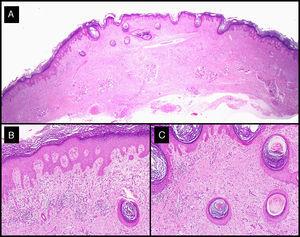 Hallazgos histológicos de la lesión residual extirpada tras la administración de MTX-il en el caso 3 (tabla 1). A-C. Presencia de una epidermis displásica asociada a un denso infiltrado inflamatorio linfohistiocitario, con alguna célula gigante a cuerpo extraño que se correspondía con el fenómeno de la regresión del QA desencadenado por el MTX-IL (hematoxilina-eosina; A: x10; B: x40; C: x100).