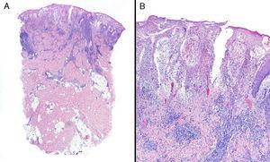 Biopsia del borde de una úlcera diagnosticada como PG: se observa un importante infiltrado inflamatorio por neutrófilos en la dermis superficial. A. Imagen izquierda: hematoxilina-eosina x4. B. Imagen derecha: hematoxilina-eosina x10.