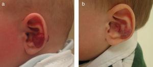 Niño de 4 meses de edad con HI de tipo focal en el pabellón auricular (a). Se indica tratamiento con propranolol oral a dosis de 2mg/kg/día, observándose una resolución prácticamente completa de la lesión al cabo de 4 meses de tratamiento (b).