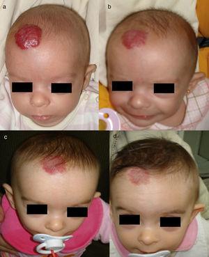 Niño de 7 semanas con un HI en el cuero cabelludo (a). A los 2 y 4 meses de tratamiento con 2mg/kg/día de propranolol se puede apreciar una mejoría sustancial, con aplanamiento de la lesión (b y c). La eliminación del HI no es completa: con frecuencia persisten placas con telangiectasias (d) que pueden ser eliminadas posteriormente con láser.