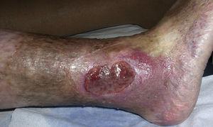 Úlcera de aspecto típicamente venoso.