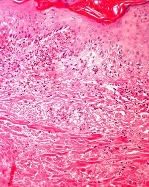 Vasculitis leucocitoclástica de pequeño vaso, así como necrosis incipiente de la epidermis. La IFD confirmó depósitos de IgA permitiendo realizar el diagnóstico de vasculitis de Shönlein-Henoch.