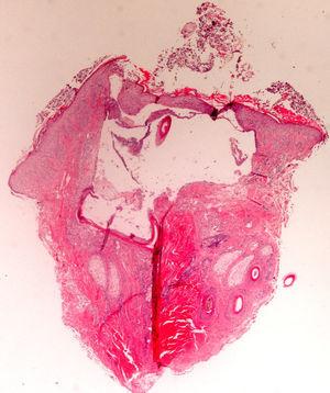 Hematoxilina-eosina x2. Biopsia muy artefactada en que se observa foliculitis, zona central vacía (artefacto de pinzamiento) y zona inferior esclerosada (artefacto de compresión).