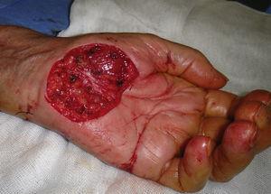 Exposición de fascia de recubrimiento de tendones flexores de mano durante extirpación de melanoma.