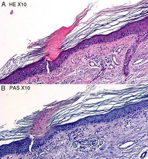 Arriba hematoxilina-eosina, x10. Lesión de poroqueratosis actínica. Abajo, PAS, x10.