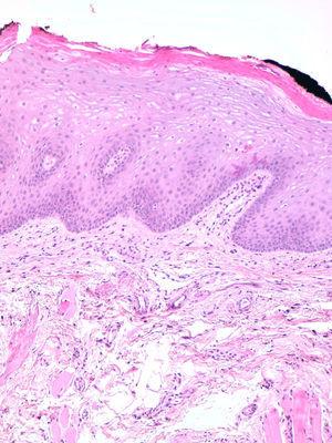 En el estudio histopatológico se observa la presencia de un edema labial con discreta ectasia de los vasos linfáticos presentes en la muestra, sin lesiones granulomatosas ni otras lesiones inflamatorias (hematoxilina-eosina x10).