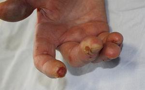 Detalle de las úlceras en pulpejos de dedos índice y medio de mano derecha.