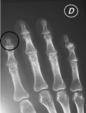 Reabsorción ósea de la falange distal del dedo índice derecho.