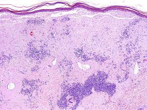 Depósito en dermis de grandes masas de amiloide, que tienden a disponerse rodeando vasos y anejos, acompañadas por un denso infiltrado de células plasmáticas.