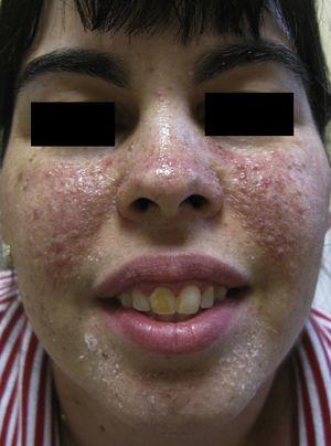 Imagen de la paciente tras tres meses de tratamiento con solución de rapamicina 1mg/ml. Disminución de lesiones y marcada mejoría del eritema subyacente.