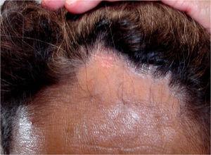 Mujer de 51 años con una placa de alopecia en banda en región fronto-temporal. Nótese la recesión de la línea de implantación del pelo.
