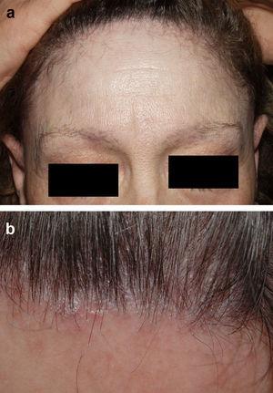 a) Alopecia frontal fibrosante. Retroceso de la línea de implantación del pelo de unos 3cm y alopecia parcial de las cejas. b) Alopecia frontal fibrosante en fase activa. Eritema e hiperqueratosis folicular.