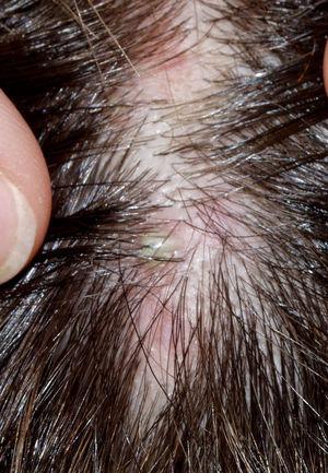 Detalle de una foliculitis decalvante en fase activa.