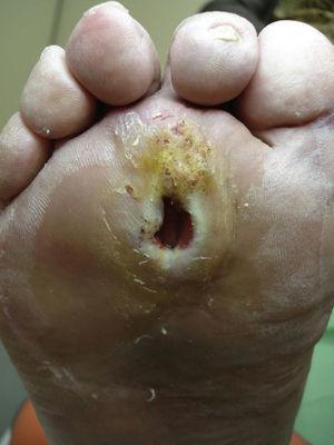 Úlcera en un pie diabético. La localización debajo de las cabezas de los metatarsos es la situación más habitual de las úlceras en los pies diabéticos. Cortesía de Enric Giralt y Elena Planell.