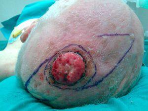 Carcinoma epidermoide en el cuero cabelludo de 4cm de diámetro con diseño de resección y colgajos en hacha.