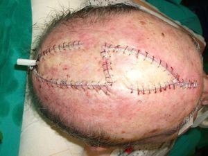 Resultado postoperatorio inmediato de resección de carcinoma epidermoide del cuero cabelludo y cobertura con colgajos en hacha bilaterales.