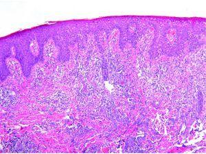 Imagen típica de una papulosis linfomatoide tipo A. Se aprecia el típico infiltrado en cuña de células grandes (H-E ×10).
