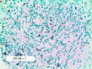 Muestra la única biopsia en la que se encontró dudoso CD56 positivo en algunas células (CD56 ×30).