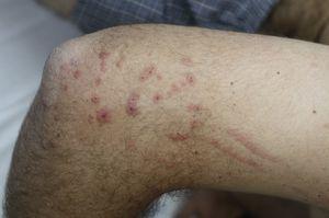 Erythematous linear arrays and erythema multiforme-like lesions on right elvow after contact with poison ivy.