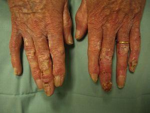 Imagen clínica previa al tratamiento con imiquimod en la que se aprecian lesiones de hiperqueratosis y ulceraciones en los dedos de ambas manos.