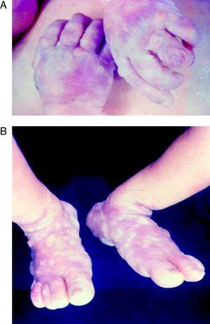 Grandes ampollas en manos (A) y pies (B) en un paciente con sífilis congénita precoz de contenido altamente contagioso (pénfigo sifilítico).