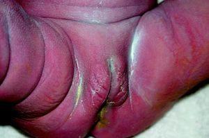 Lesiones genitales y perianales típicas de sífilis congénita precoz.