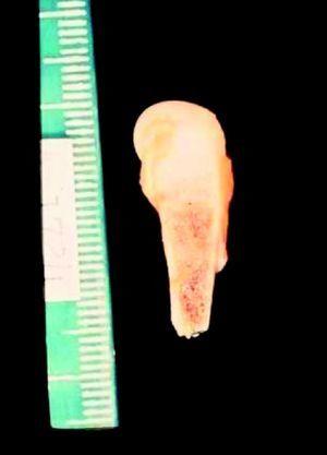 Fémur con irregularidades en la línea epifisaria, periostio engrosado y con un área nodular blanca en la médula correspondiente a un goma.