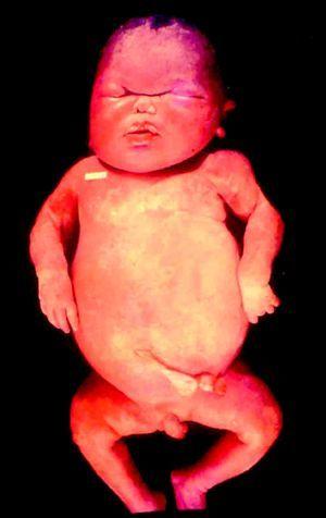 Hidrops fetal en recién nacido con sífilis congénita que sobrevivió varias horas.